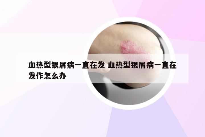 血热型银屑病一直在发 血热型银屑病一直在发作怎么办