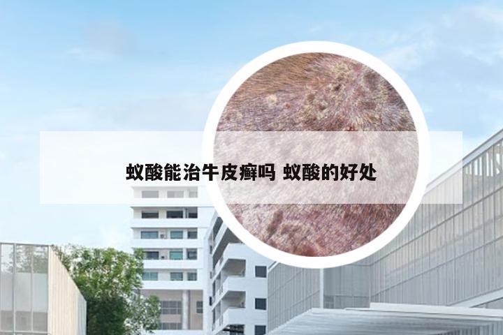 蚁酸能治牛皮癣吗 蚁酸的好处