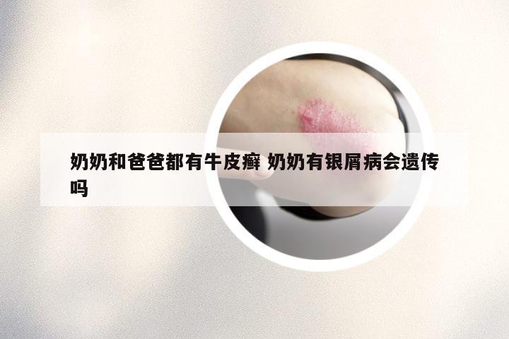 奶奶和爸爸都有牛皮癣 奶奶有银屑病会遗传吗