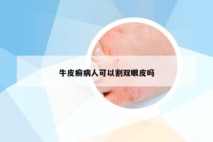 牛皮癣病人可以割双眼皮吗