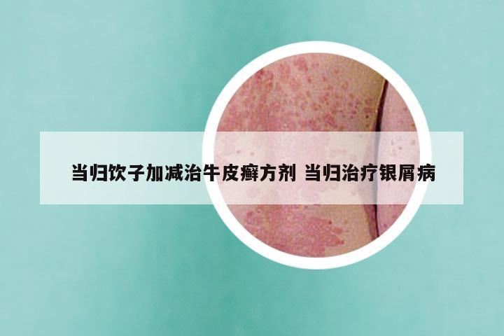 当归饮子加减治牛皮癣方剂 当归治疗银屑病