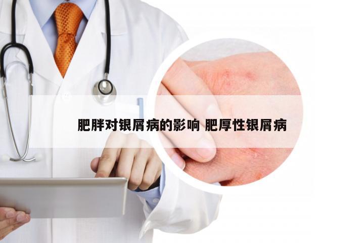 肥胖对银屑病的影响 肥厚性银屑病