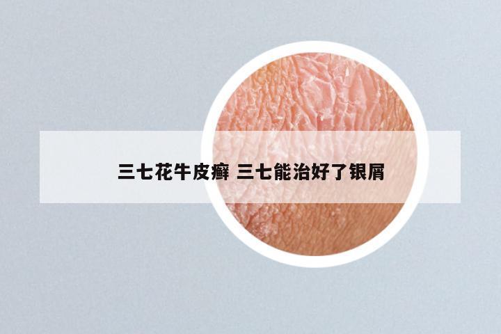 三七花牛皮癣 三七能治好了银屑