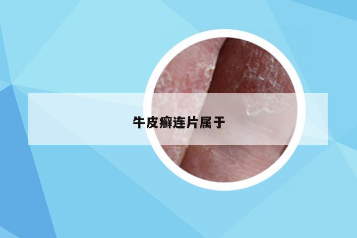 牛皮癣连片属于