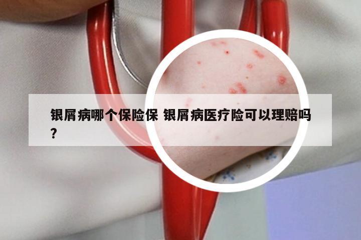 银屑病哪个保险保 银屑病医疗险可以理赔吗?