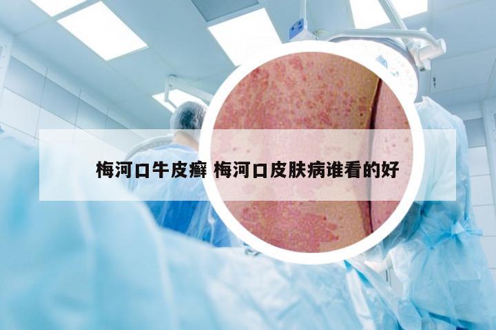 梅河口牛皮癣 梅河口皮肤病谁看的好