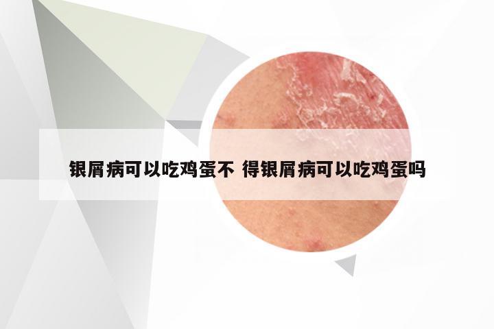 银屑病可以吃鸡蛋不 得银屑病可以吃鸡蛋吗