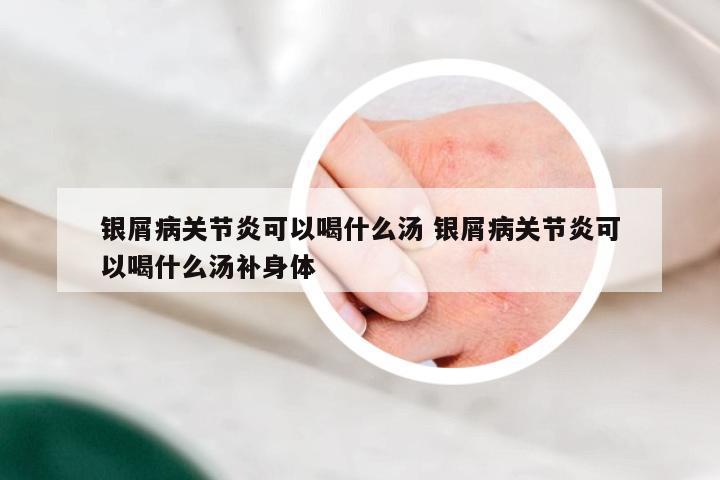 银屑病关节炎可以喝什么汤 银屑病关节炎可以喝什么汤补身体