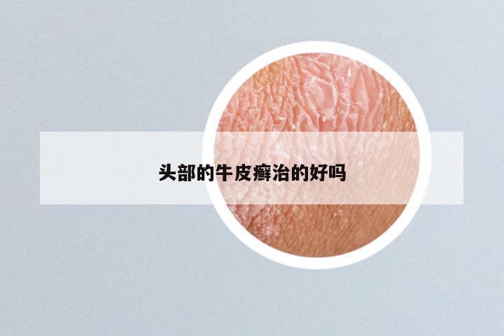 头部的牛皮癣治的好吗