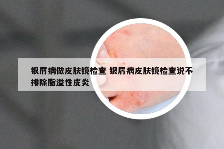 银屑病做皮肤镜检查 银屑病皮肤镜检查说不排除脂溢性皮炎