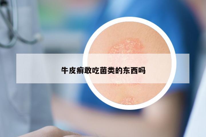 牛皮癣敢吃菌类的东西吗