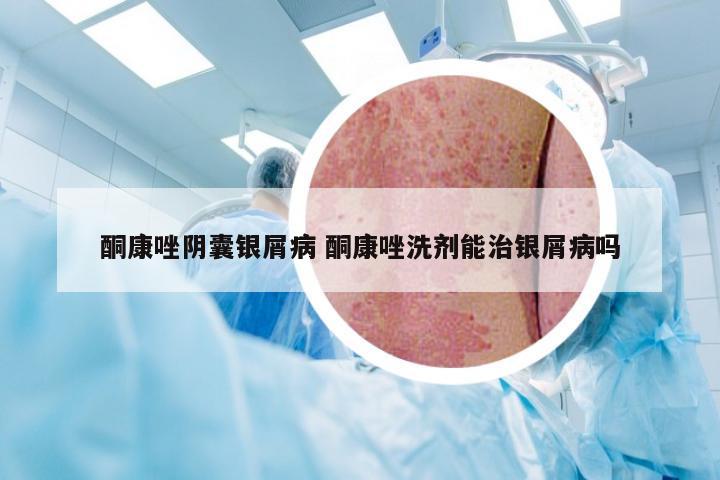 酮康唑阴囊银屑病 酮康唑洗剂能治银屑病吗
