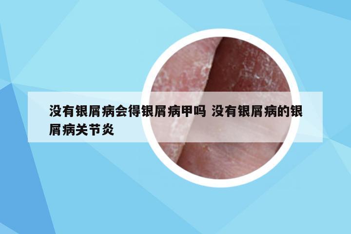 没有银屑病会得银屑病甲吗 没有银屑病的银屑病关节炎