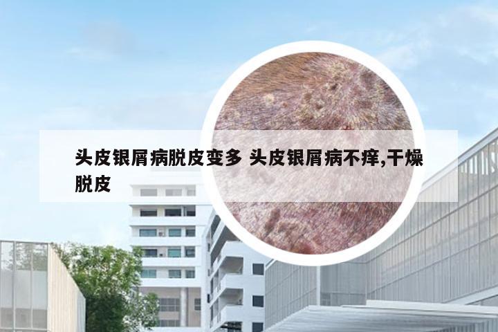 头皮银屑病脱皮变多 头皮银屑病不痒,干燥脱皮