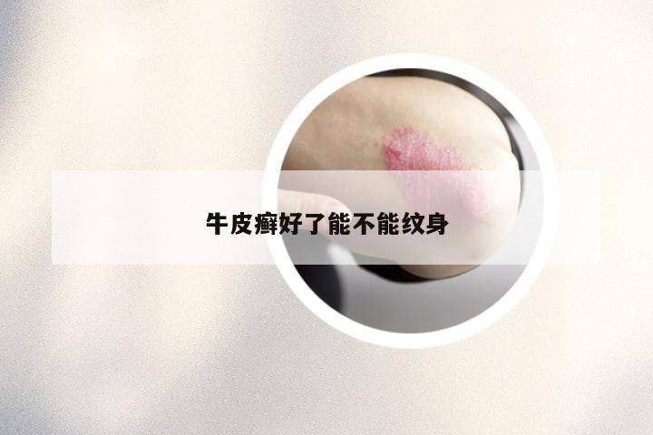 牛皮癣好了能不能纹身