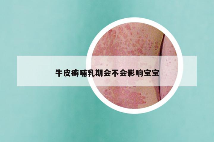 牛皮癣哺乳期会不会影响宝宝