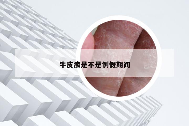牛皮癣是不是例假期间
