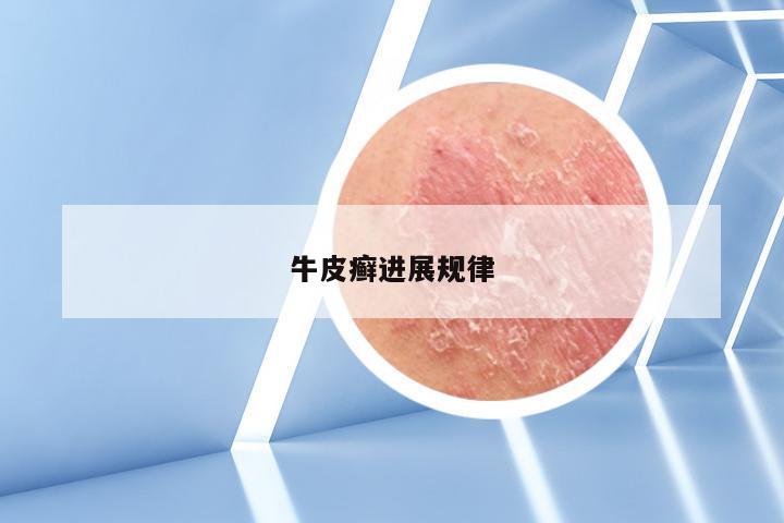 牛皮癣进展规律
