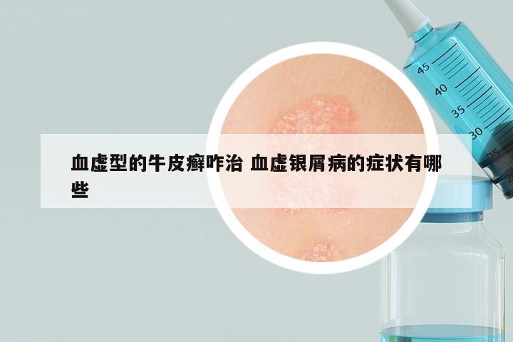 血虚型的牛皮癣咋治 血虚银屑病的症状有哪些