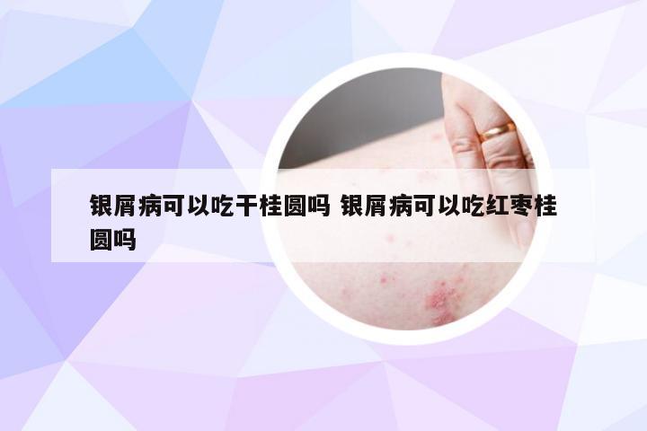 银屑病可以吃干桂圆吗 银屑病可以吃红枣桂圆吗
