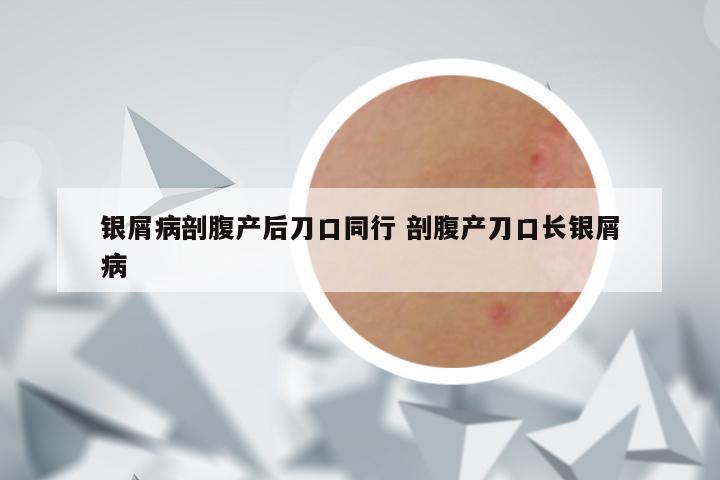 银屑病剖腹产后刀口同行 剖腹产刀口长银屑病
