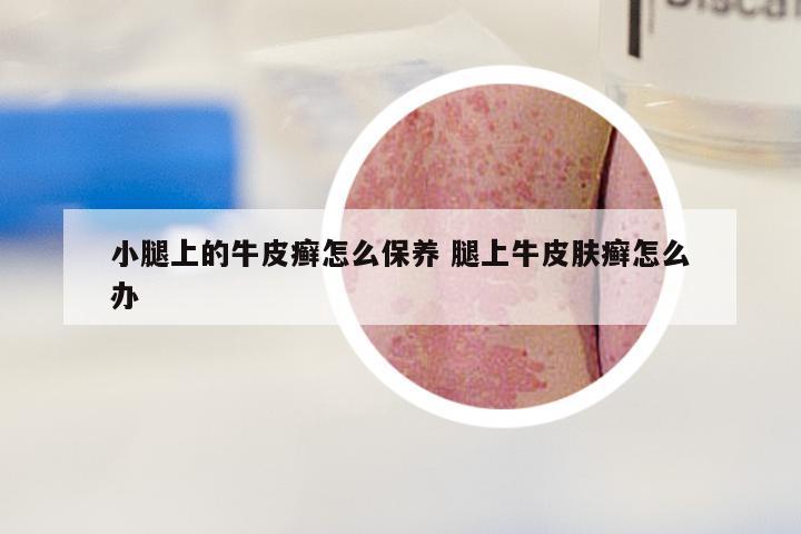小腿上的牛皮癣怎么保养 腿上牛皮肤癣怎么办