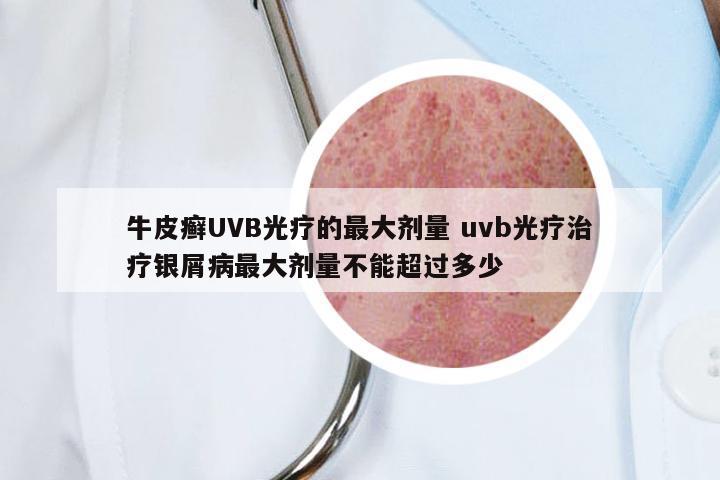 牛皮癣UVB光疗的最大剂量 uvb光疗治疗银屑病最大剂量不能超过多少