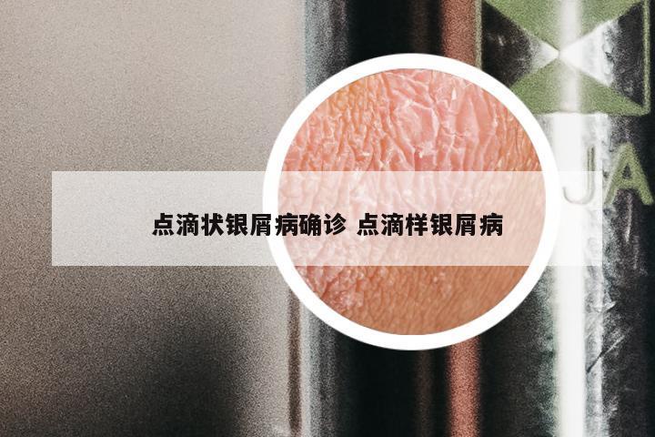 点滴状银屑病确诊 点滴样银屑病