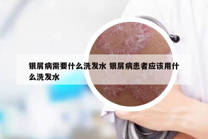 银屑病需要什么洗发水 银屑病患者应该用什么洗发水