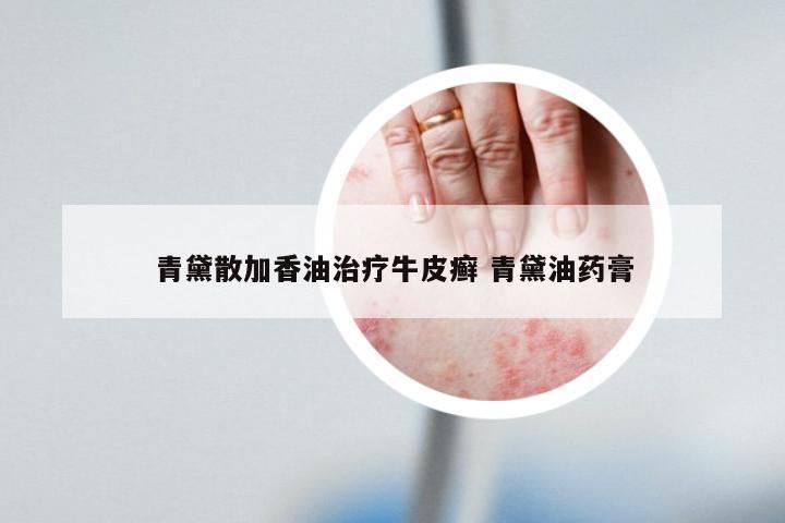 青黛散加香油治疗牛皮癣 青黛油药膏