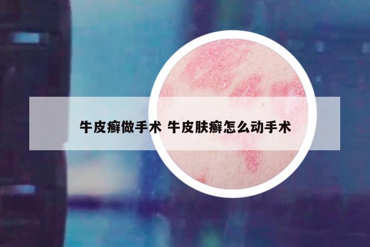 牛皮癣做手术 牛皮肤癣怎么动手术