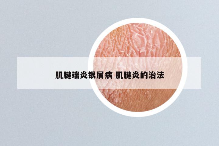 肌腱端炎银屑病 肌腱炎的治法