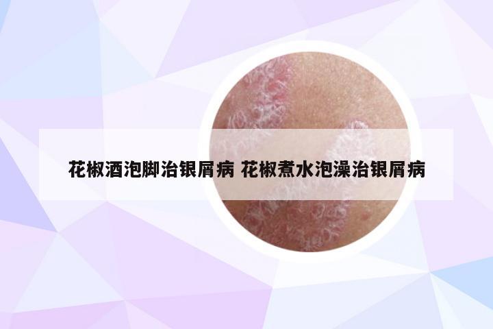 花椒酒泡脚治银屑病 花椒煮水泡澡治银屑病