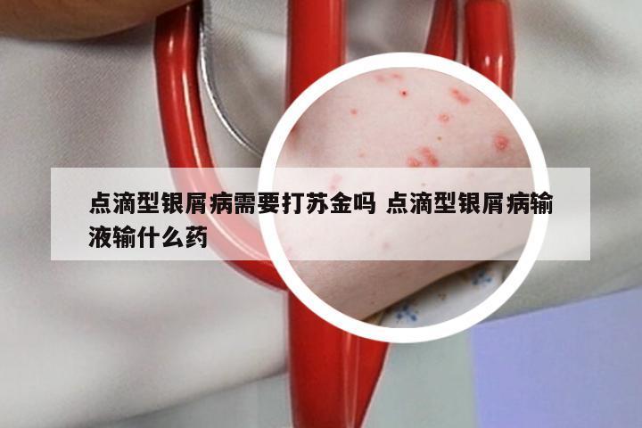 点滴型银屑病需要打苏金吗 点滴型银屑病输液输什么药