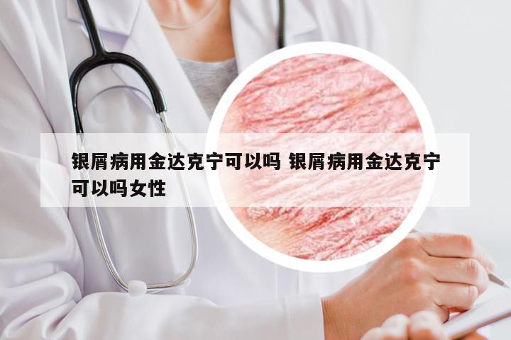 银屑病用金达克宁可以吗 银屑病用金达克宁可以吗女性