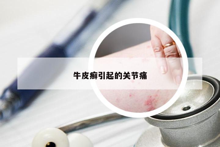 牛皮癣引起的关节痛