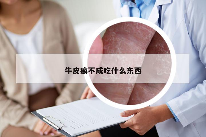 牛皮癣不成吃什么东西