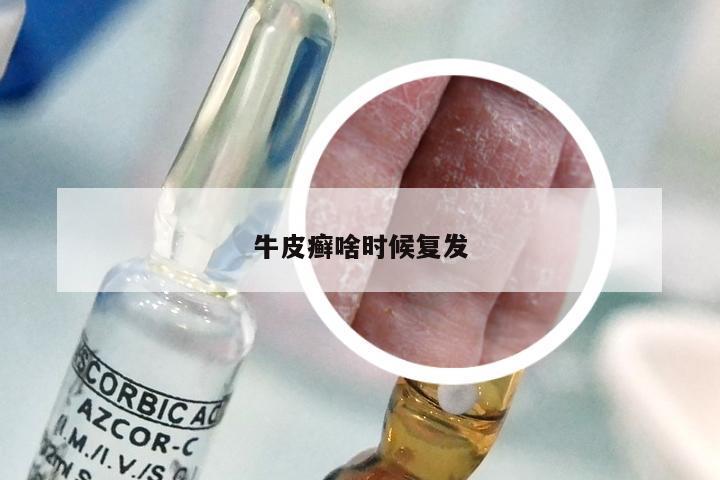 牛皮癣啥时候复发