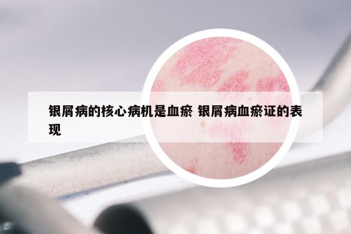 银屑病的核心病机是血瘀 银屑病血瘀证的表现