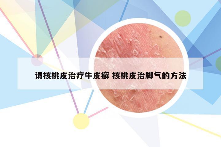 请核桃皮治疗牛皮癣 核桃皮治脚气的方法