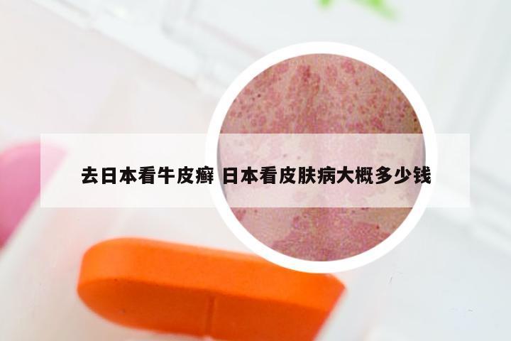 去日本看牛皮癣 日本看皮肤病大概多少钱