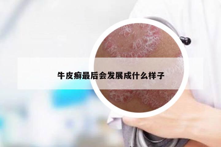 牛皮癣最后会发展成什么样子