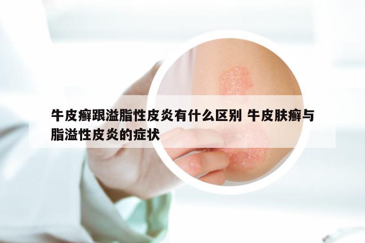 牛皮癣跟溢脂性皮炎有什么区别 牛皮肤癣与脂溢性皮炎的症状