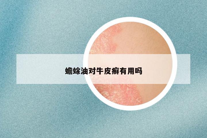 蟾蜍油对牛皮癣有用吗