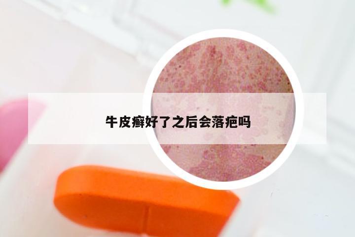 牛皮癣好了之后会落疤吗