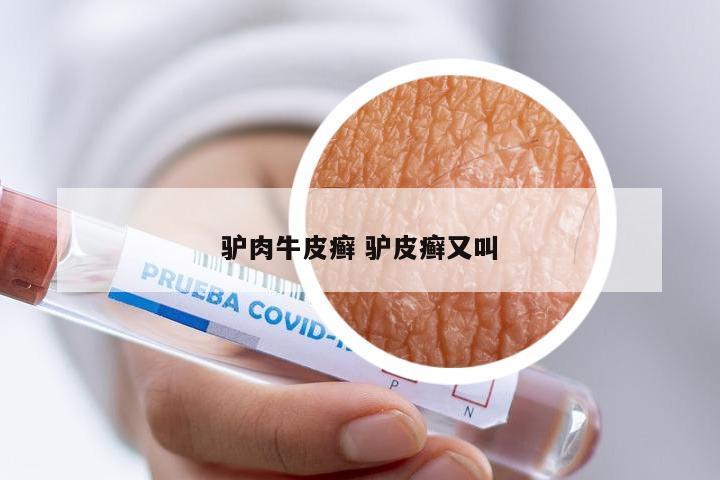 驴肉牛皮癣 驴皮癣又叫