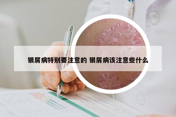 银屑病特别要注意的 银屑病该注意些什么