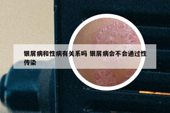 银屑病和性病有关系吗 银屑病会不会通过性传染
