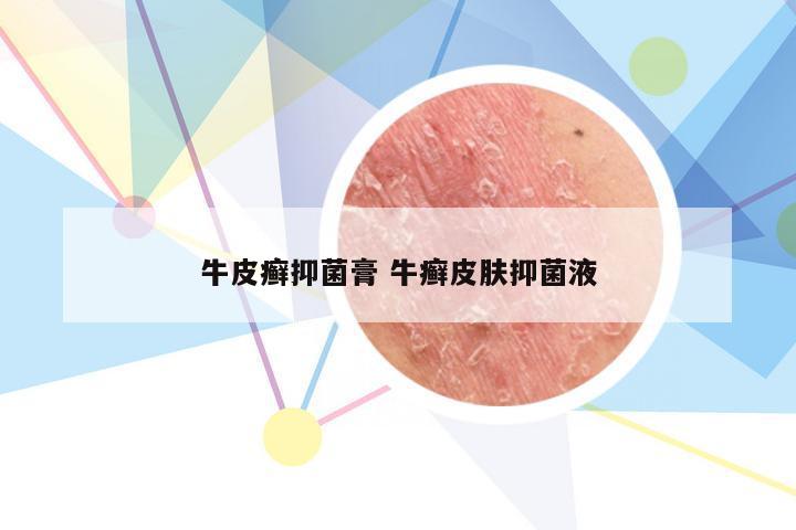 牛皮癣抑菌膏 牛癣皮肤抑菌液