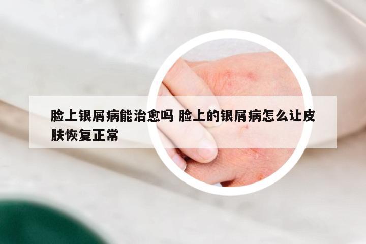 脸上银屑病能治愈吗 脸上的银屑病怎么让皮肤恢复正常